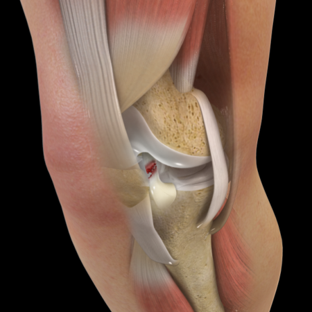 acl tear 768x576 1